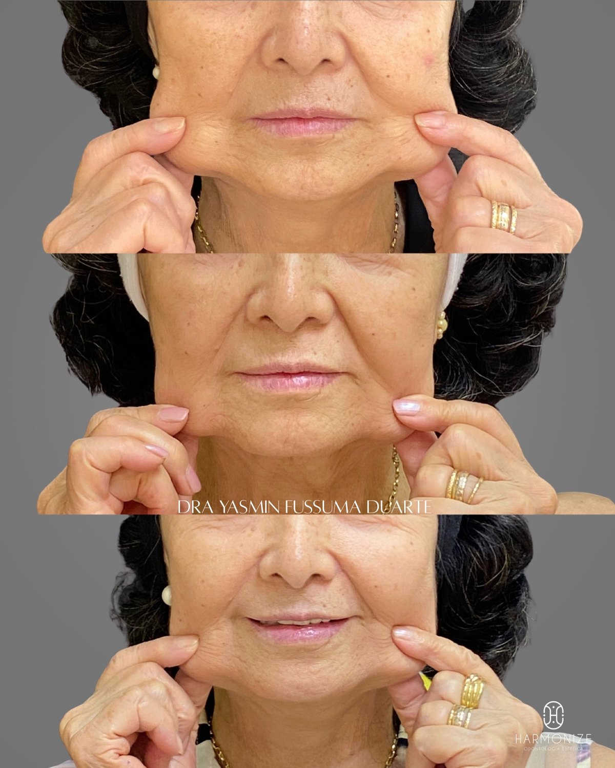 Bioestimulador de colágeno: antes e depois