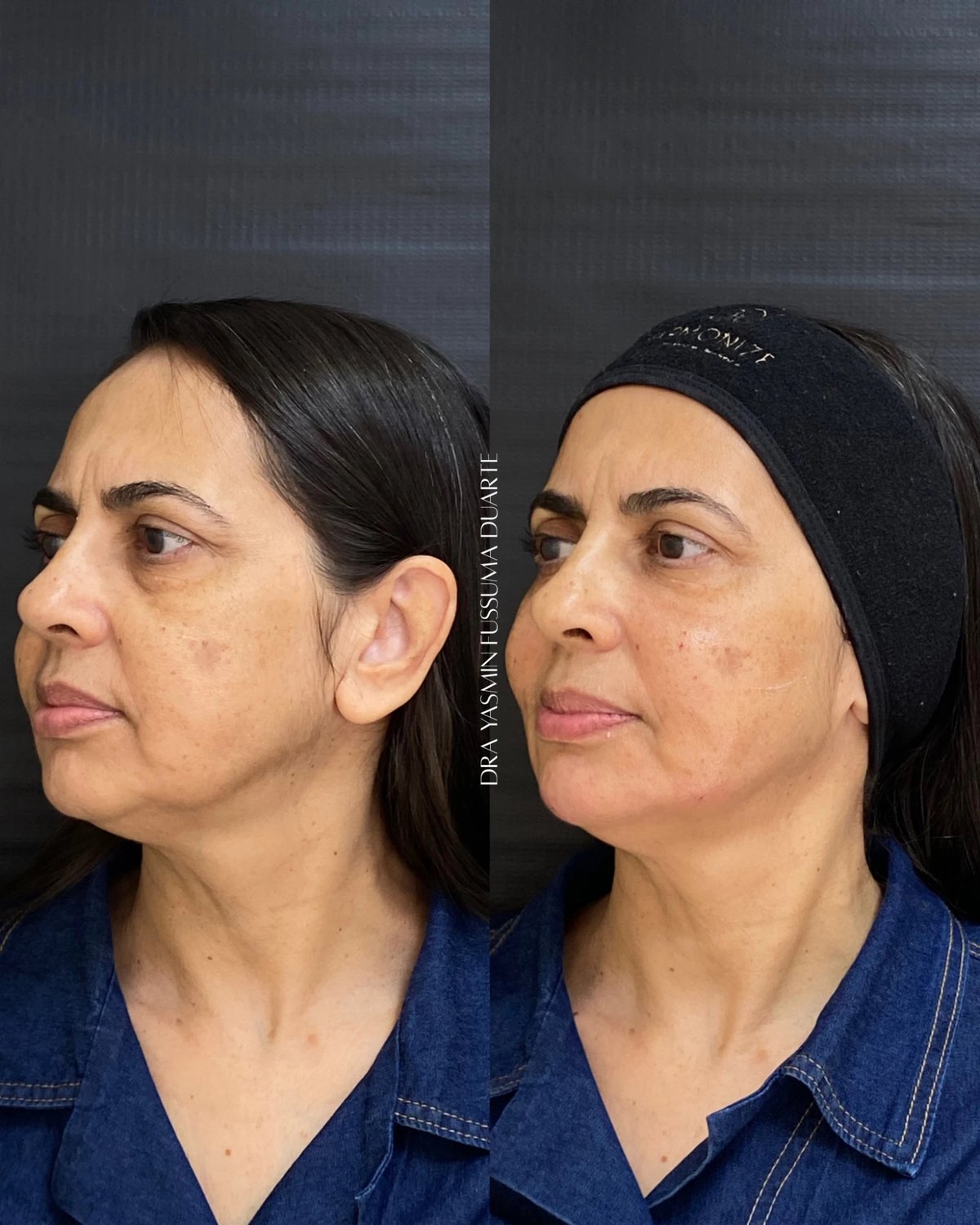 Preenchimento facial: antes e depois