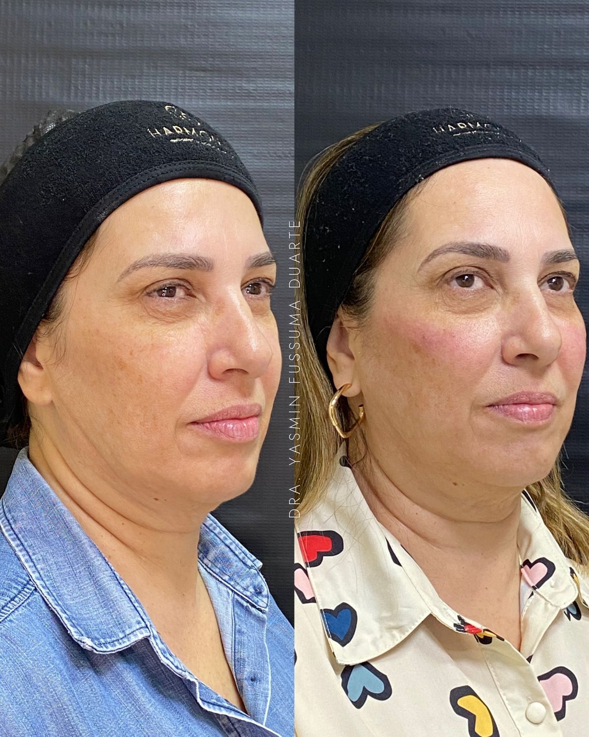 Preenchimento facial (malar): antes e depois