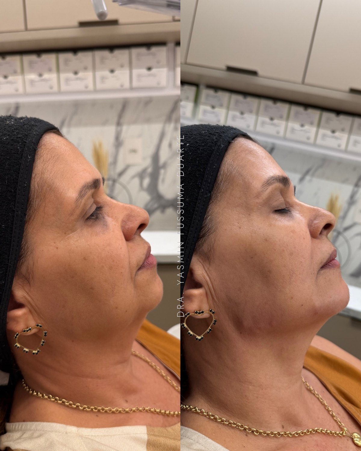 Preenchimento facial (contorno facial): antes e depois