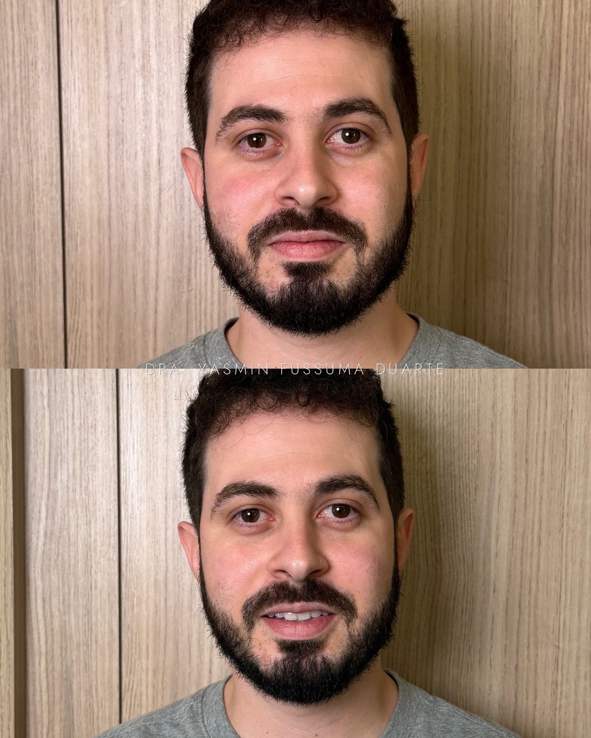 Preenchimento facial (olheiras): antes e depois