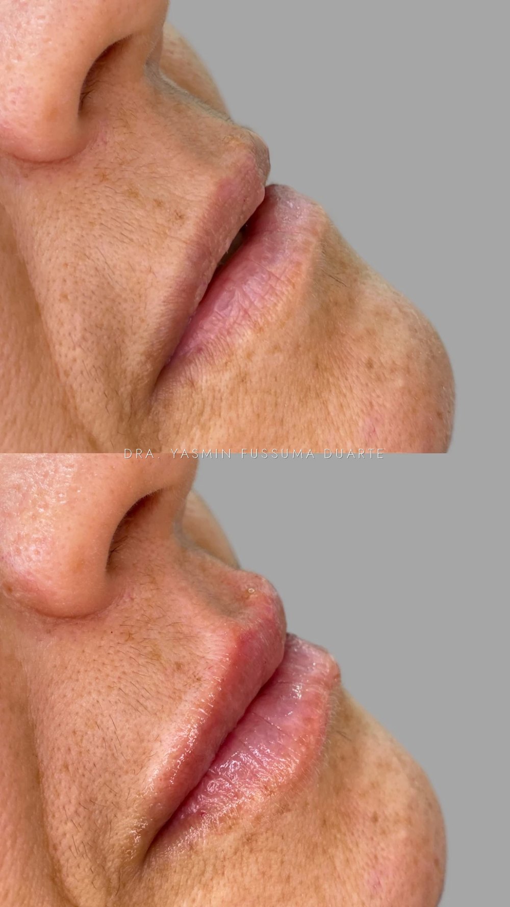 Preenchimento labial: antes e depois