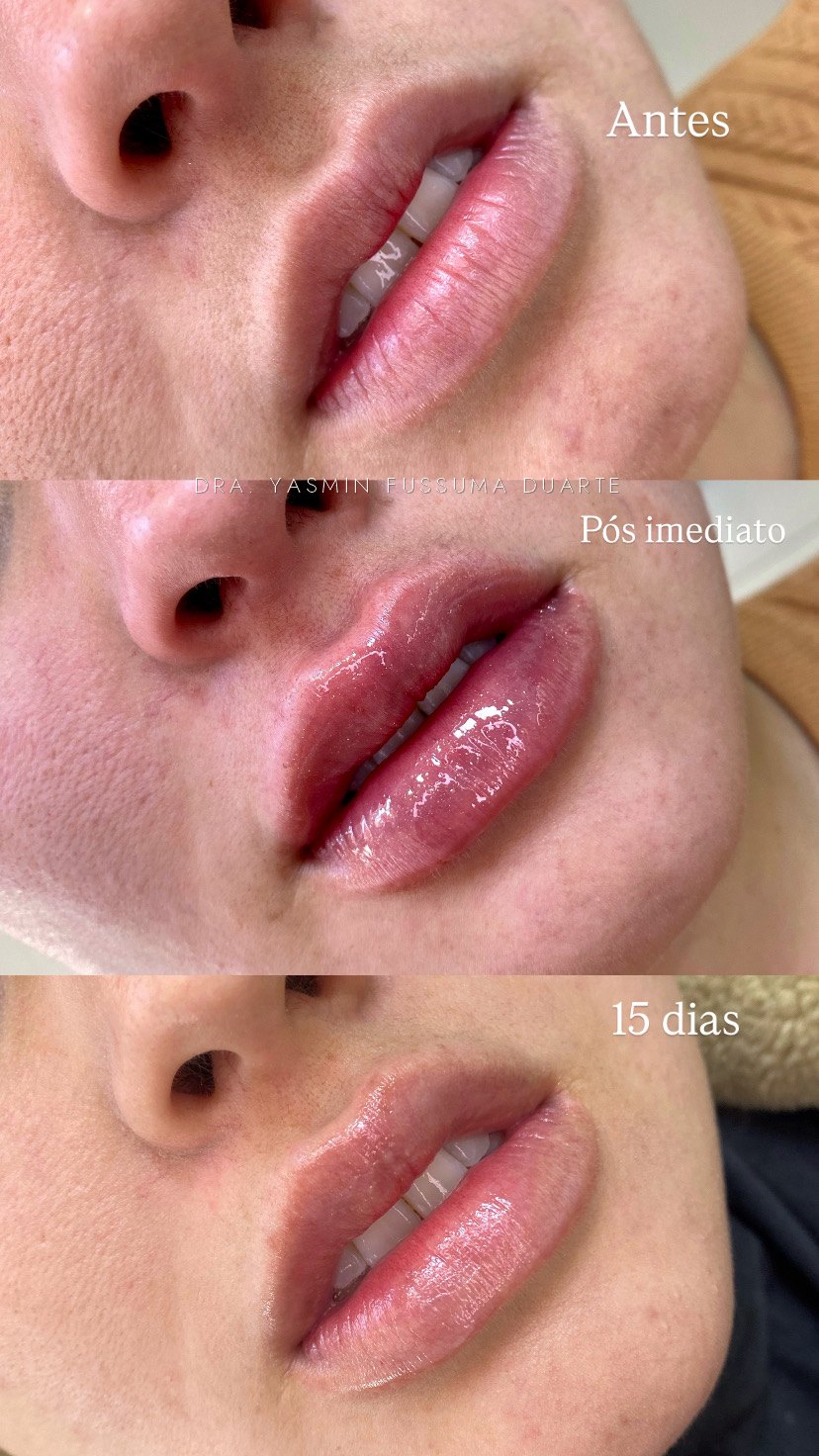 Preenchimento labial: antes e depois