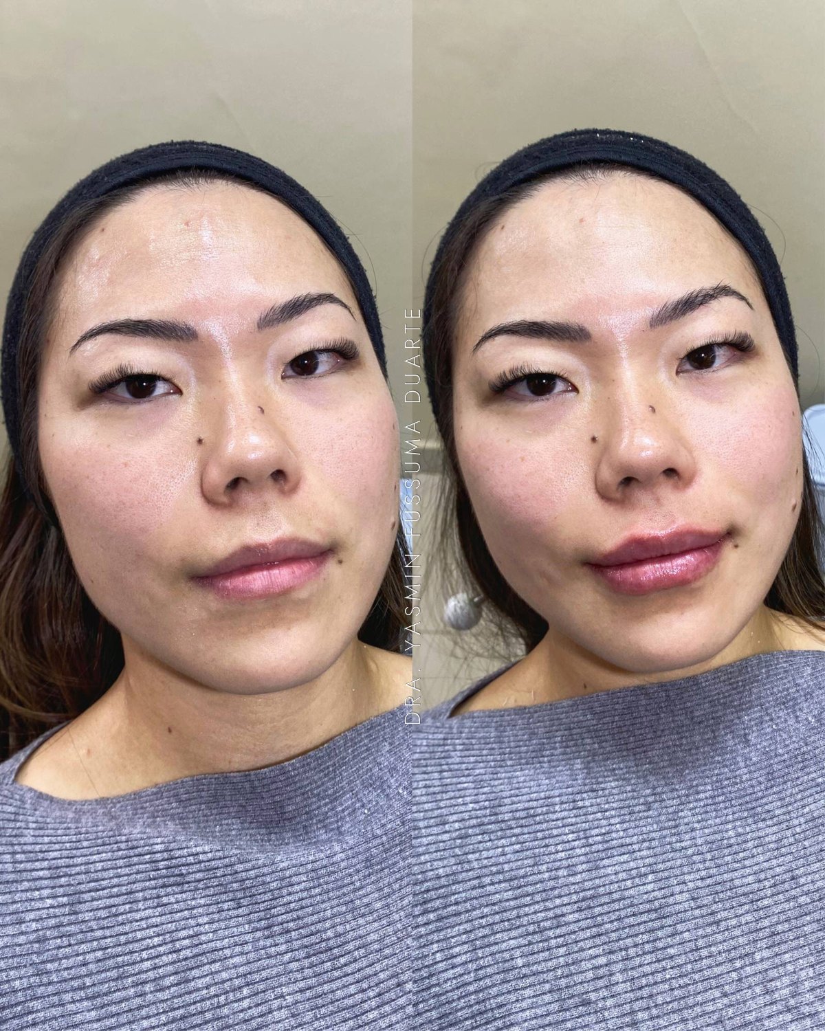Preenchimento labial: antes e depois