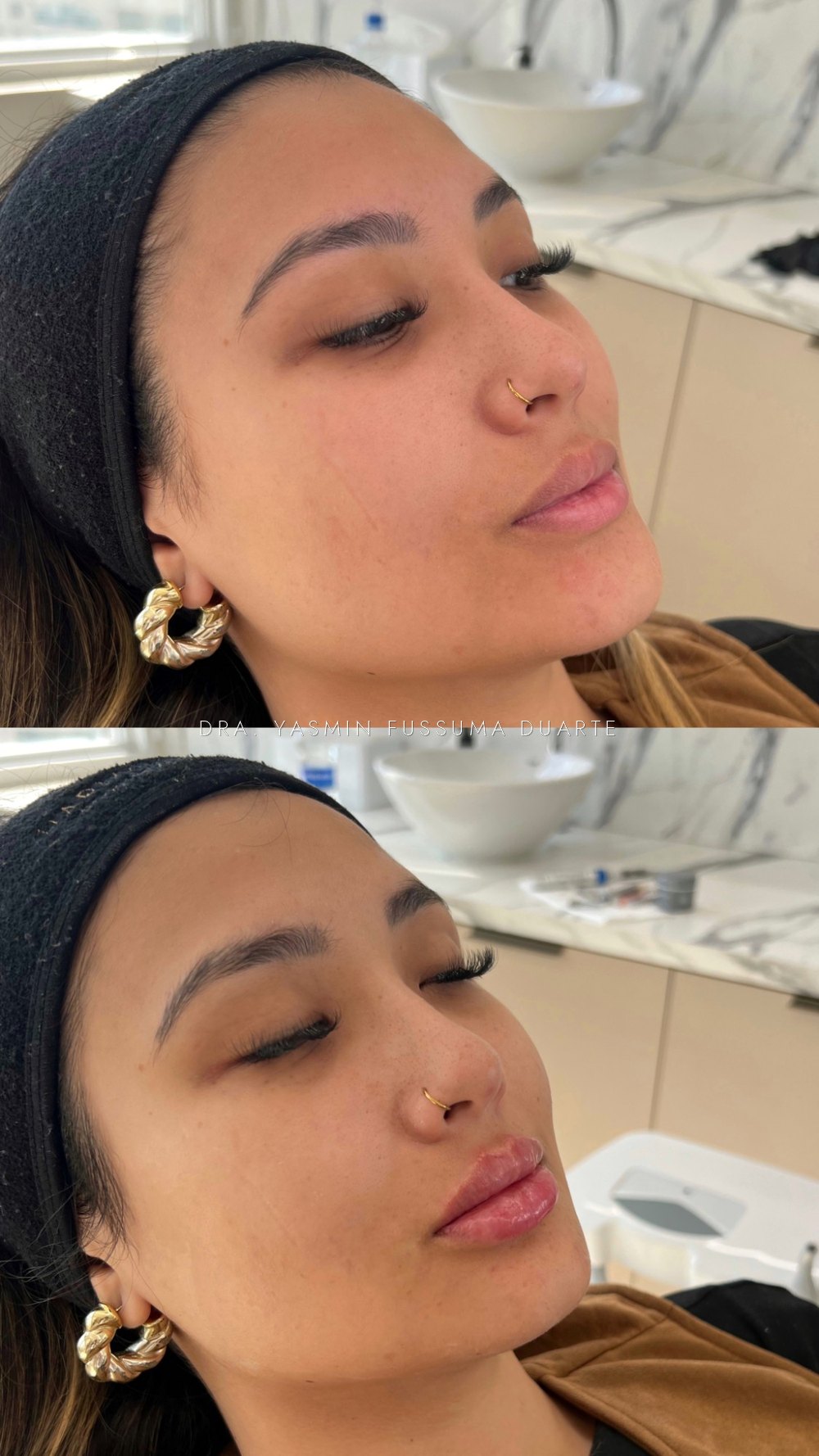 Preenchimento labial: antes e depois