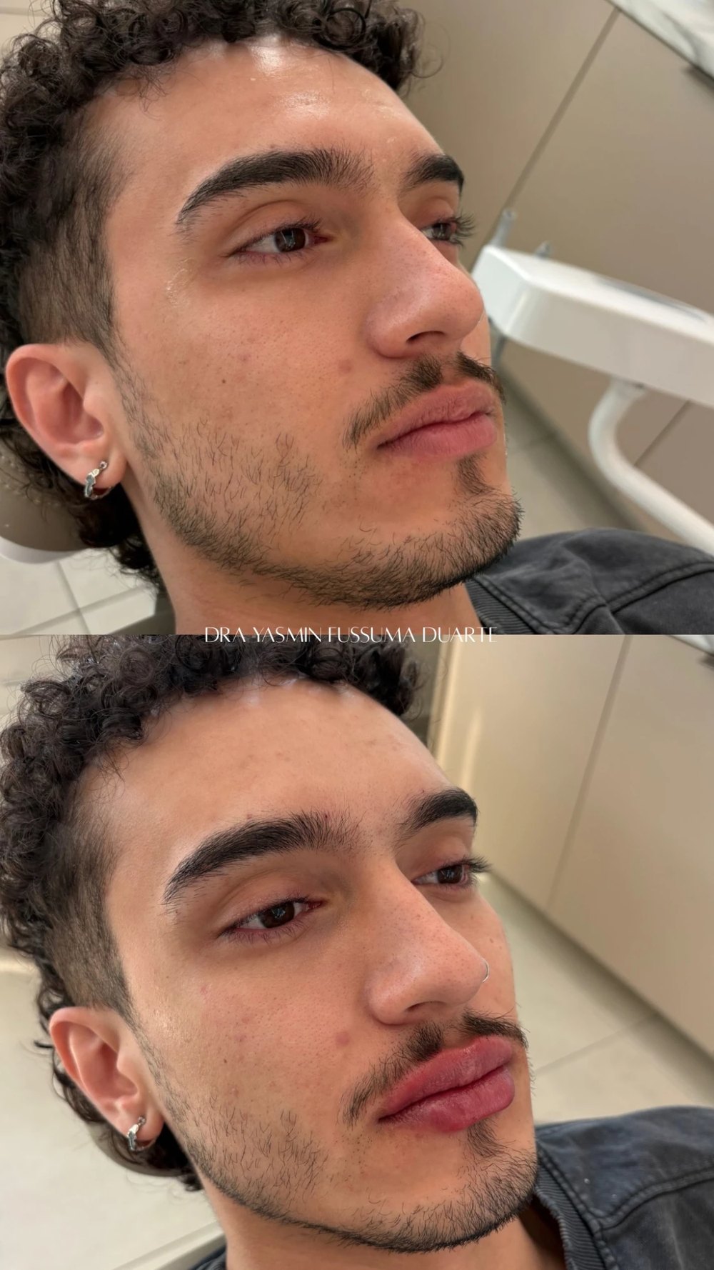 Preenchimento labial: antes e depois