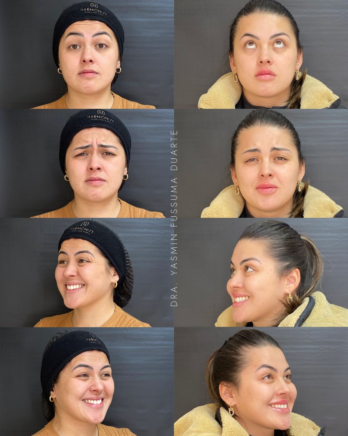Toxina botulínica: antes e depois
