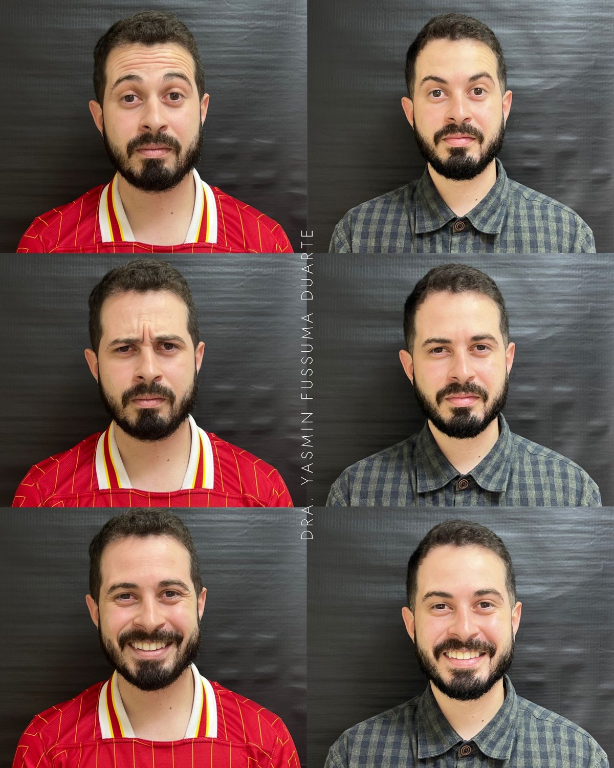 Toxina botulínica: antes e depois